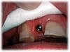 Das Zahnfleisch ist um das Implantat reizlos verheilt